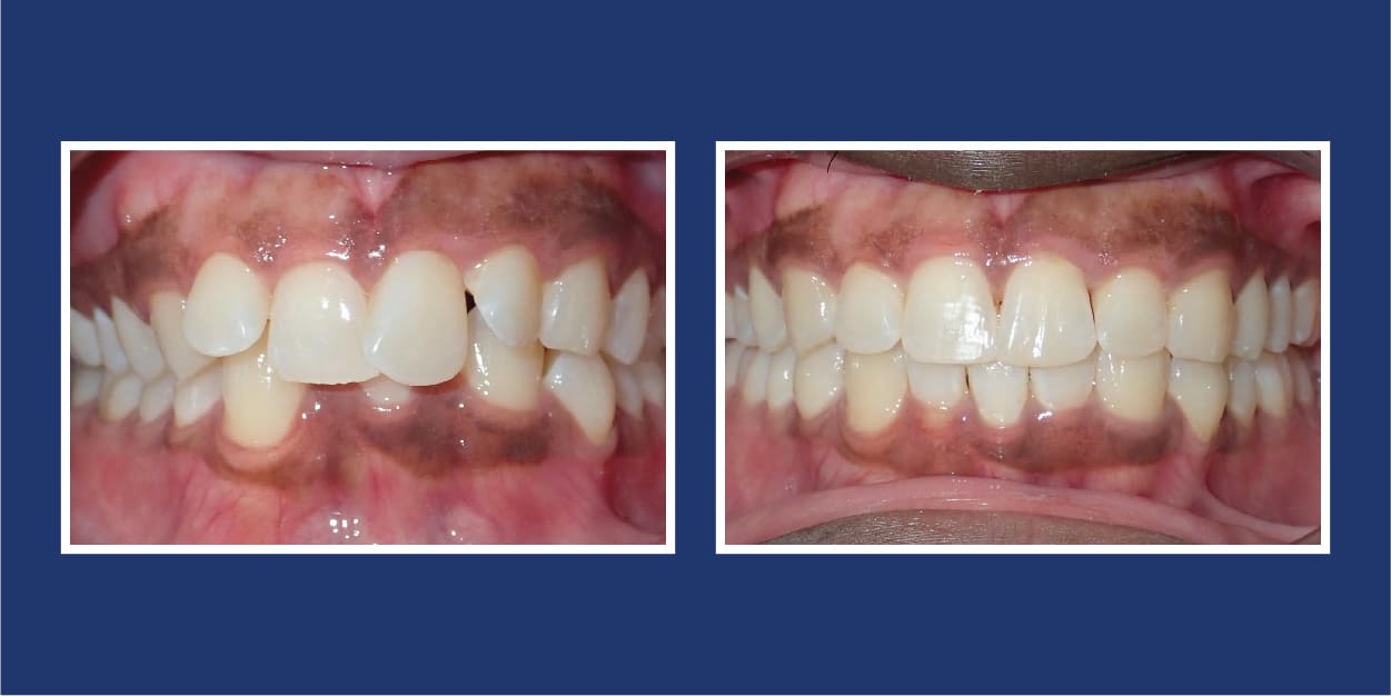 Before and After Orthodontics by Petrous in Royal Oak Michigan
