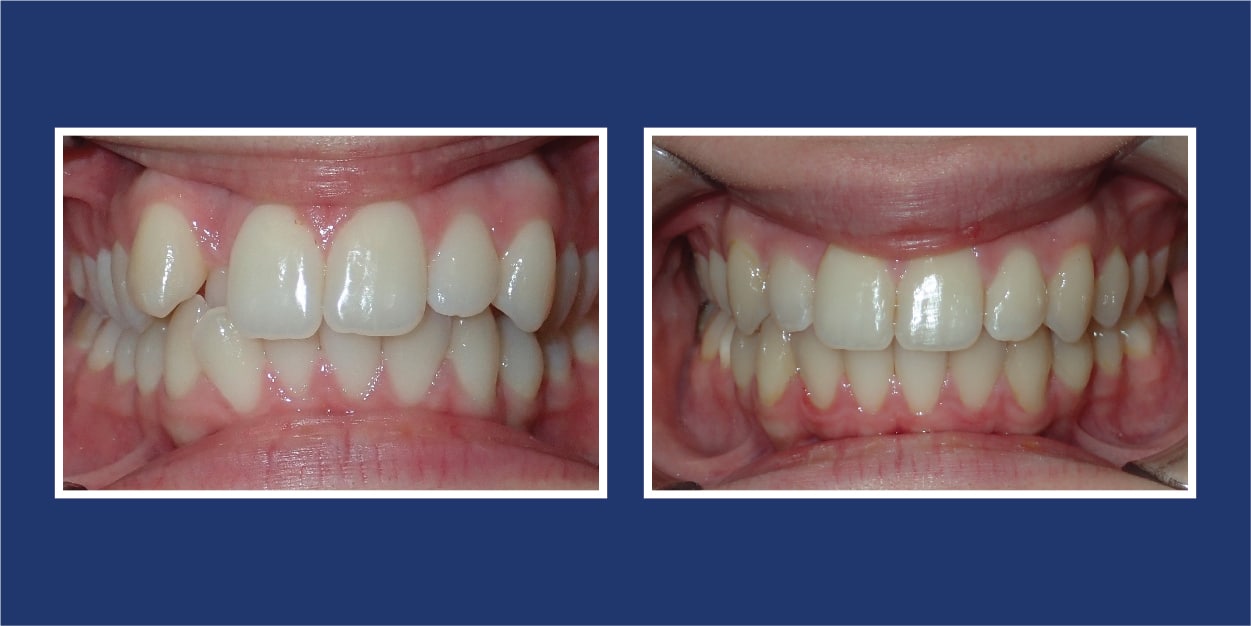 Before and after orthodontics by Petrous in Royal Oak, Michigan