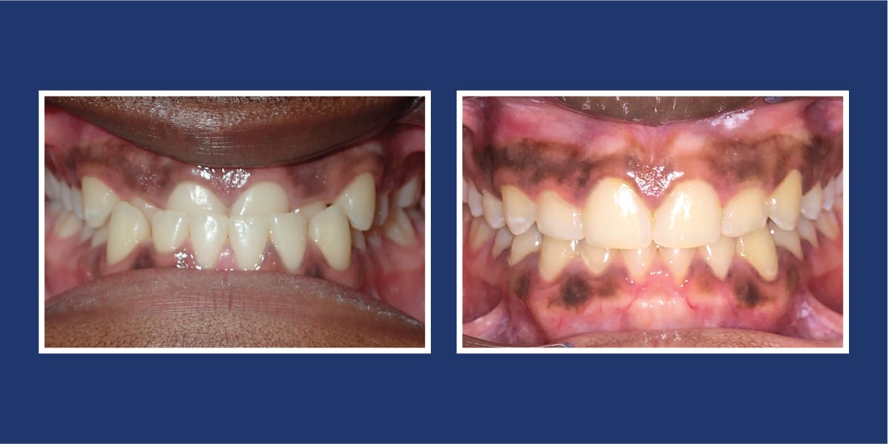 Before and after orthodontics treatment at Petrous in Royal Oak