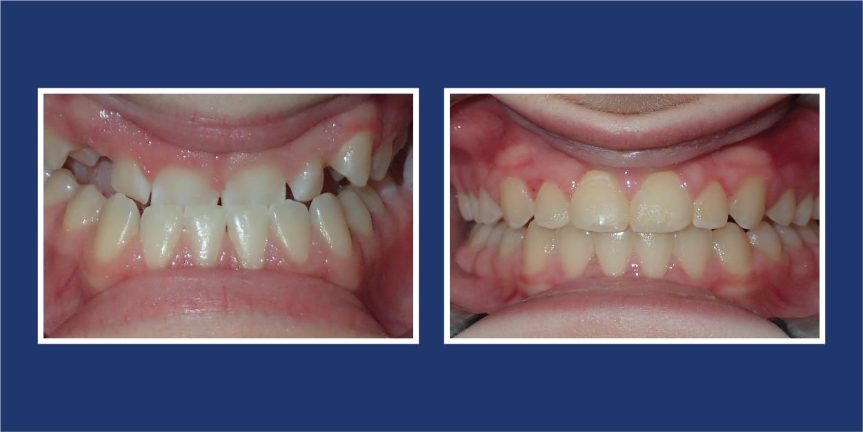 Before and after orthodontics at Petrous in Royal Oak, Michigan