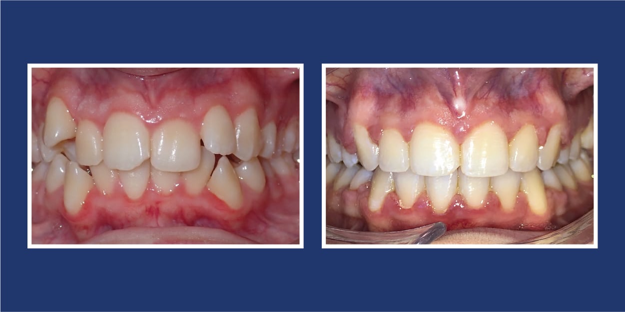 Before and after orthodontics at Petrous in Royal Oak, Michigan