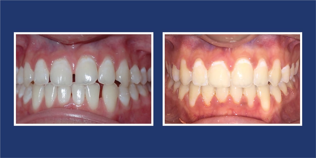 Before and After Orthodontics in Royal Oak, Michigan