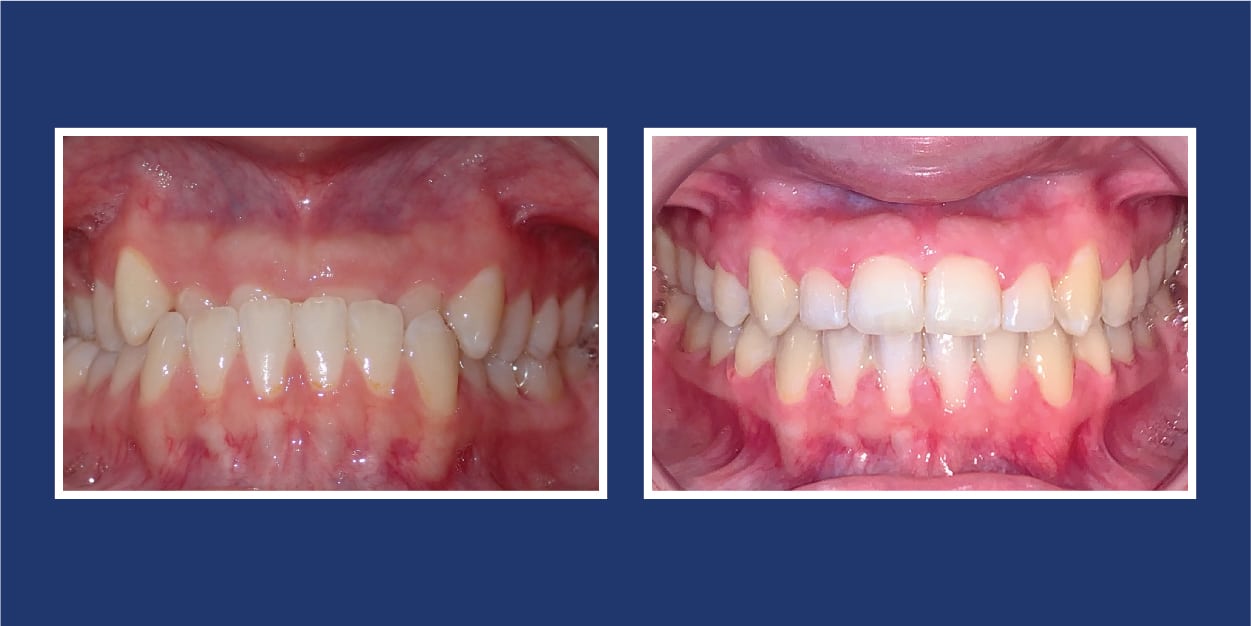 Before and After Orthodontics Petrous in Royal Oak Michigan