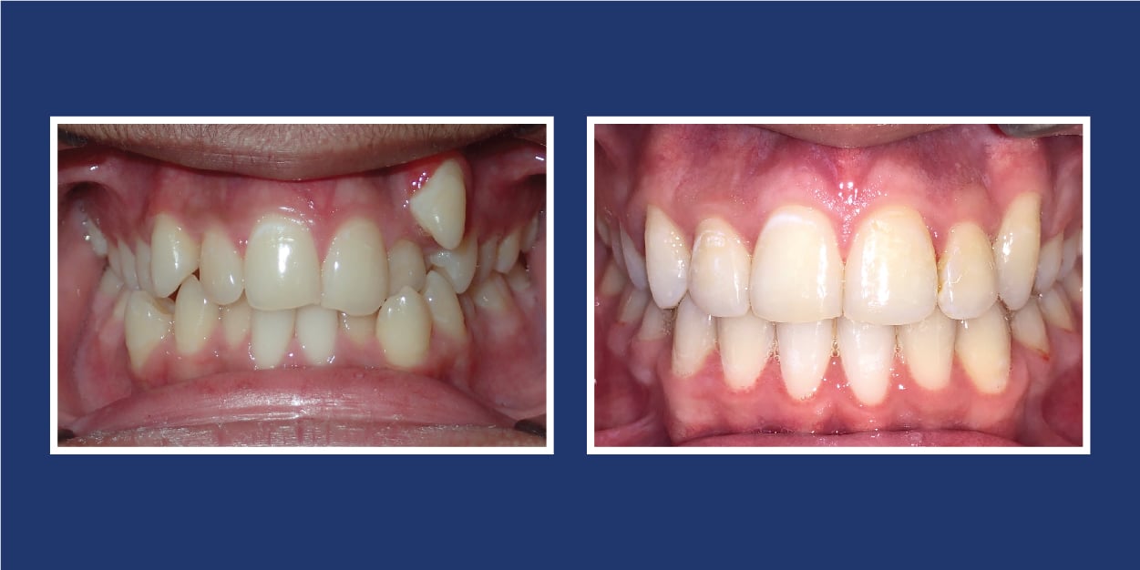 Before and After Orthodontics in Royal Oak Michigan