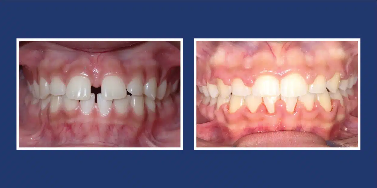 Before and After Orthodontics at Petrous in Royal Oak, Michigan