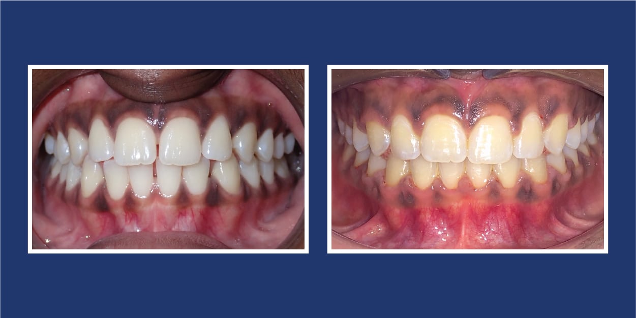 Before and After Orthodontics at Petrous in Royal Oak, Michigan