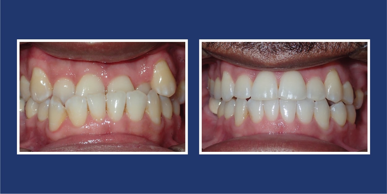 Before and After Orthodontics at Petrous in Royal Oak, Michigan