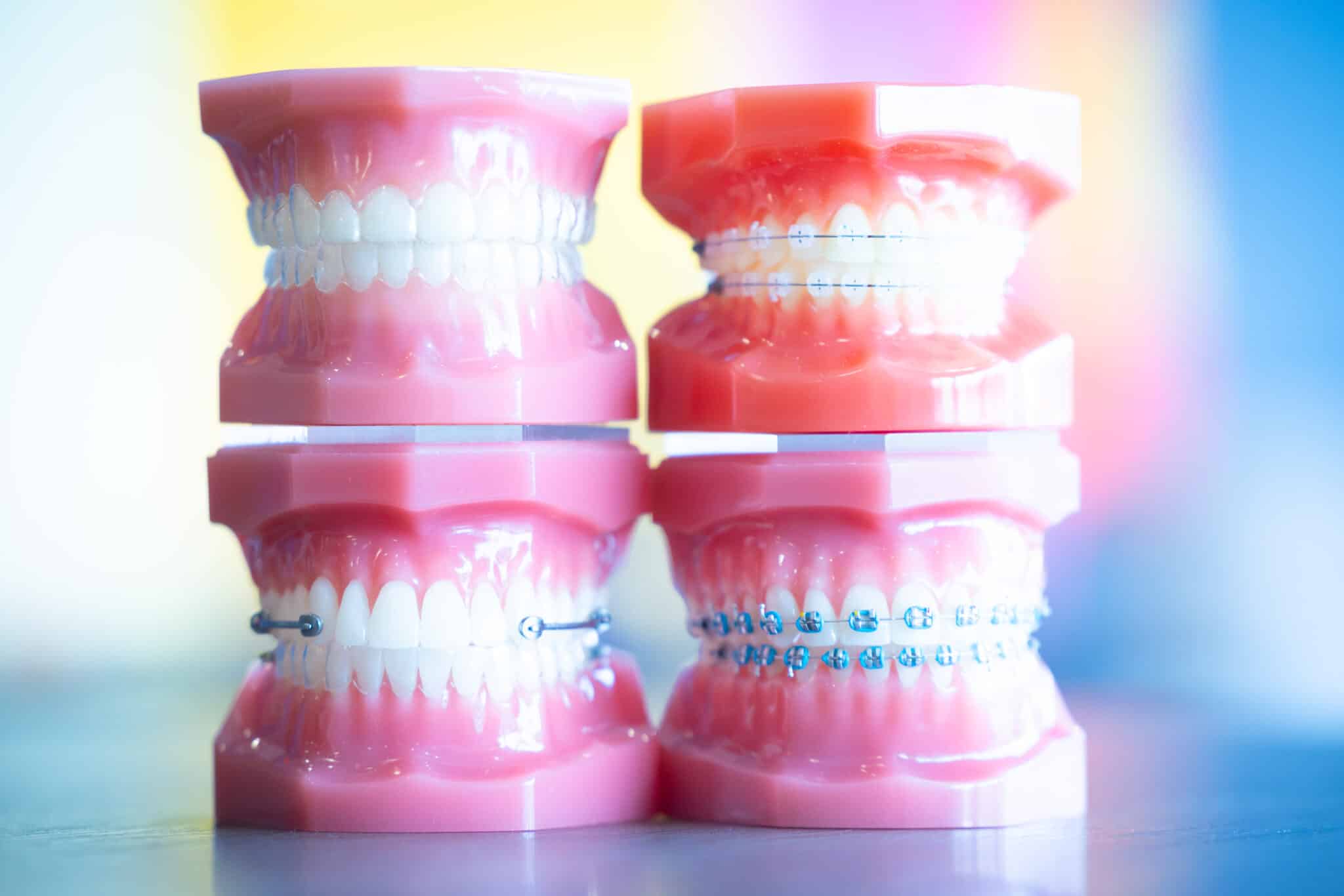 braces vs invisalign