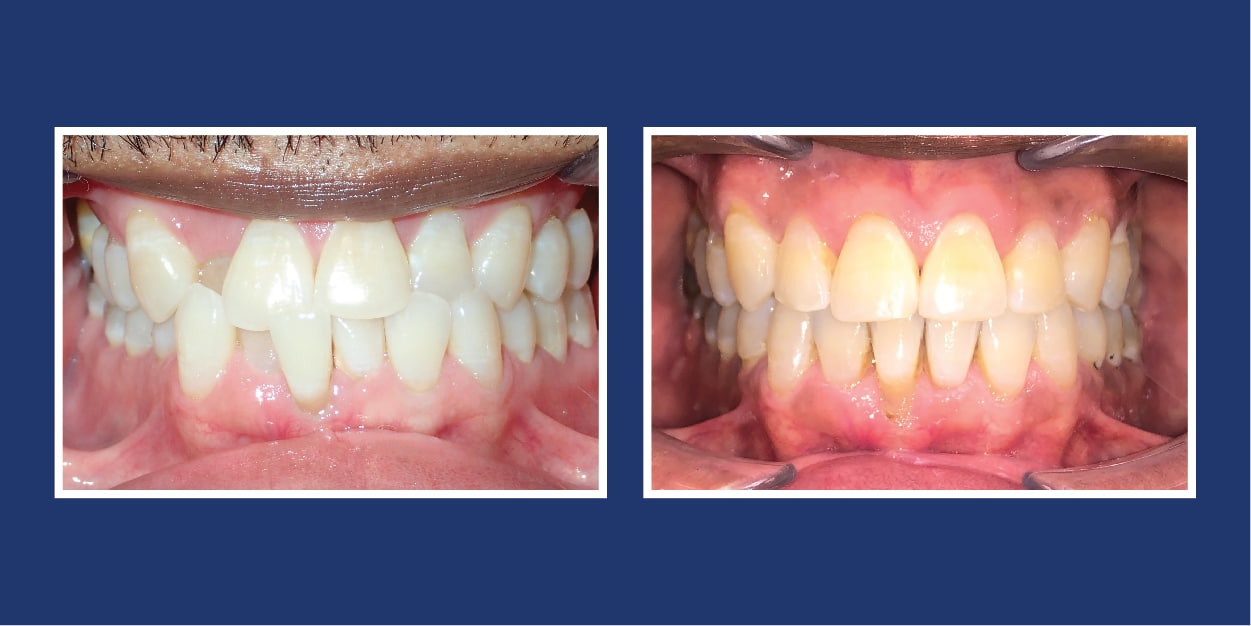 Before and After Orthodontics by Petrous in Royal Oak, Michigan